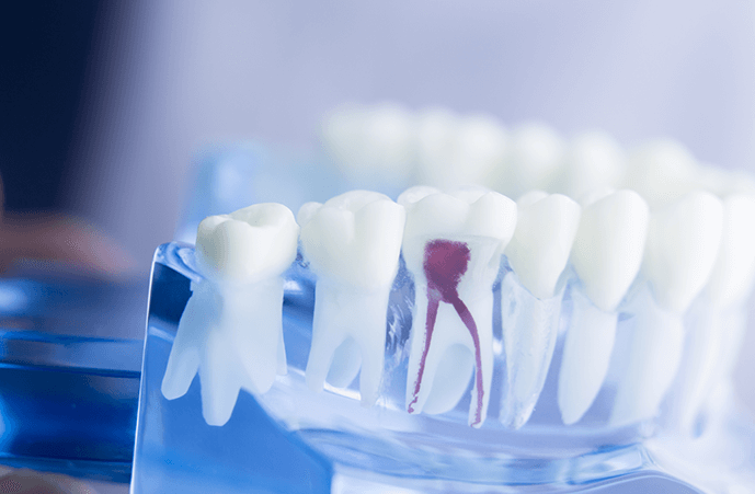 Root Canal vs. Tooth Removal: Which is More Effective? – Creating Beautiful Natural Smiles For Life