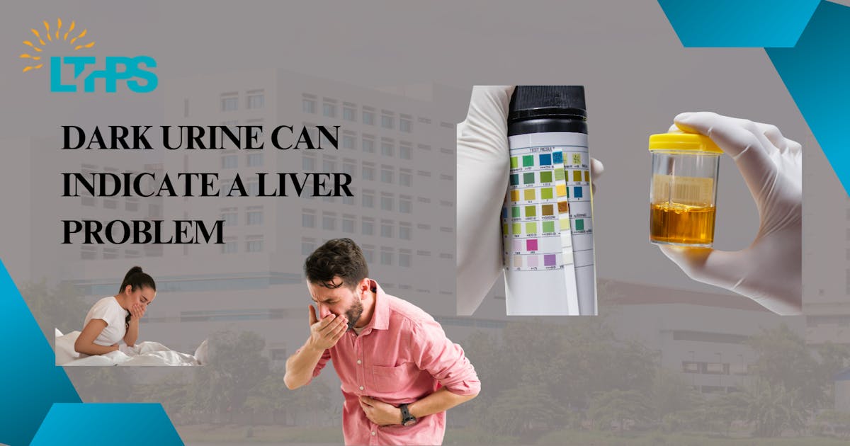 Dark Urine can Indicate a Liver Problem