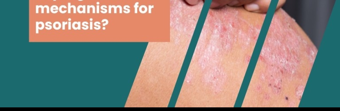 scalp psoriasis treatment Cover Image