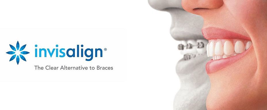 Discreet Teeth Straightening with Invisalign in Preston