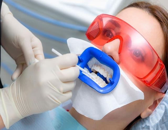 How Dental Sealants Can Protect Your Teeth against Cavities | Journal