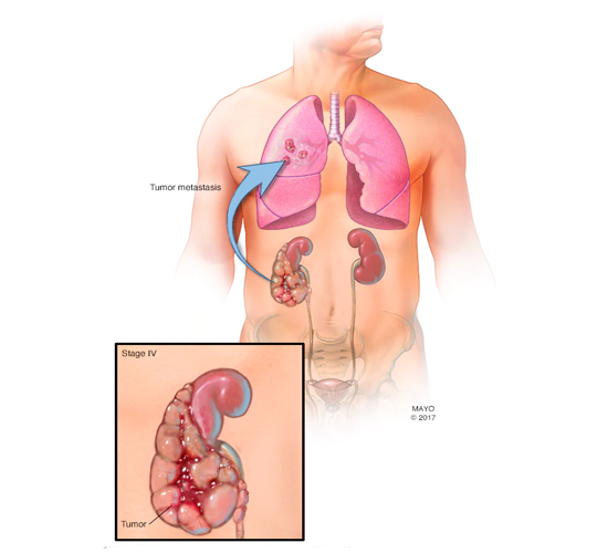 Kidney Cancer Treatment in Delhi: Comprehensive Care for Better Outcomes | by Dr. Anshuman Agarwal | Dec, 2024 | Medium