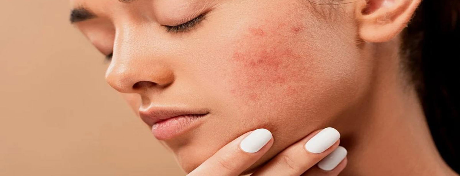 From Micro-needling to Lasers: Best Acne Scars Treatment in Bhubaneswar – Radiance Skin and Hair Clinic – Best Skin Clinic in Odisha