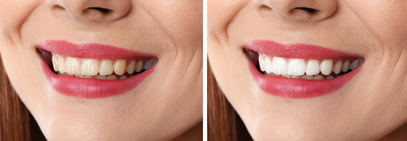 Smile Makeovers in Preston | Transform Your Smile with Confidence