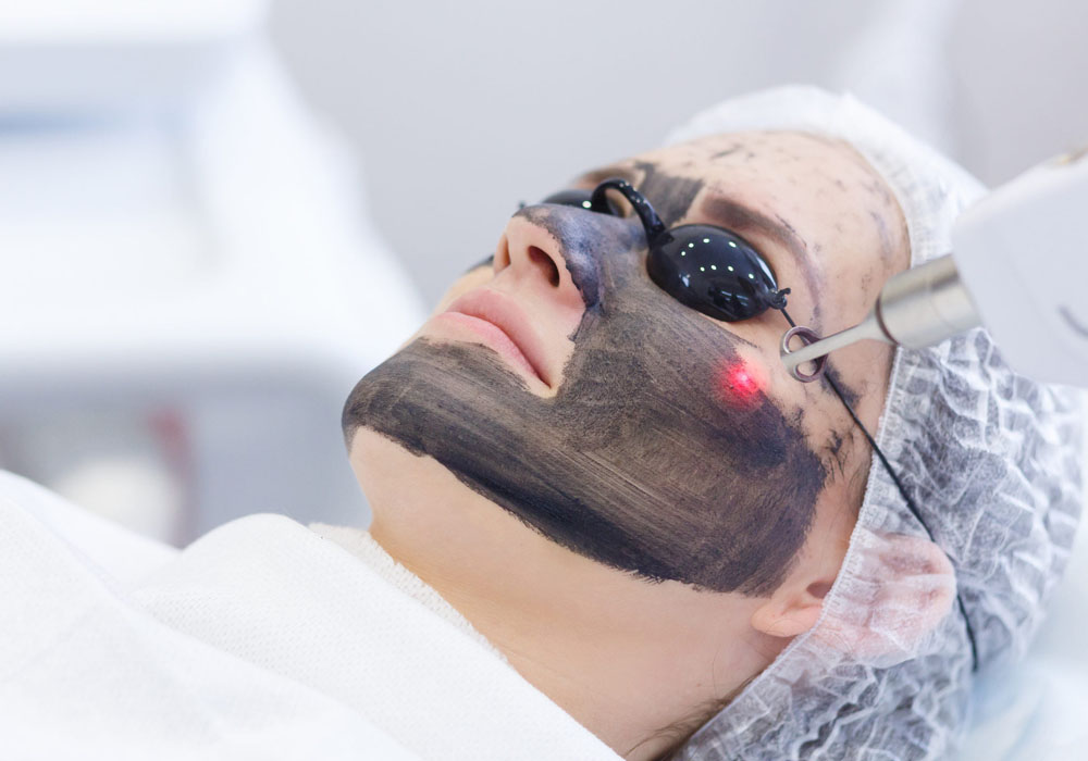 Carbon Laser Facial in Jaipur : Lady Loyall Clinic Jaipur