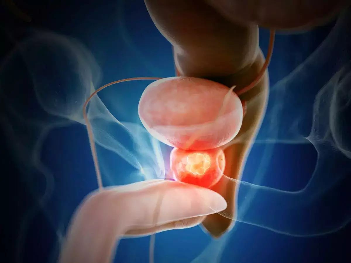 Prostate Cancer Test in Delhi: A Guide to Early Detection and Treatment | by Dr Vikas Kidney Care | Dec, 2024 | Medium