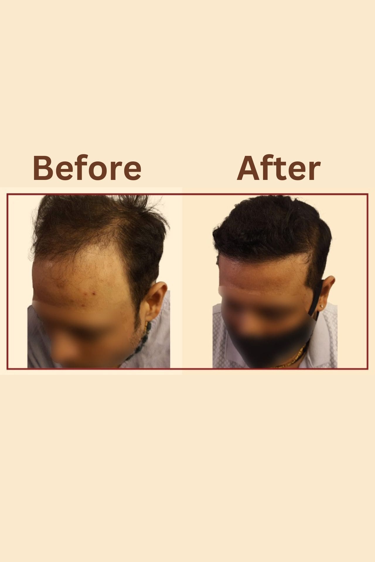 Best Hair Transplant in Delhi - Crown - The Hair Transplant Experts