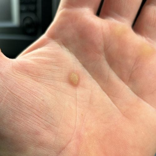 How to Identify When a Wart Requires Professional Attention? | by A.H.Advanced Skin Specialist | Apr, 2025 | Medium