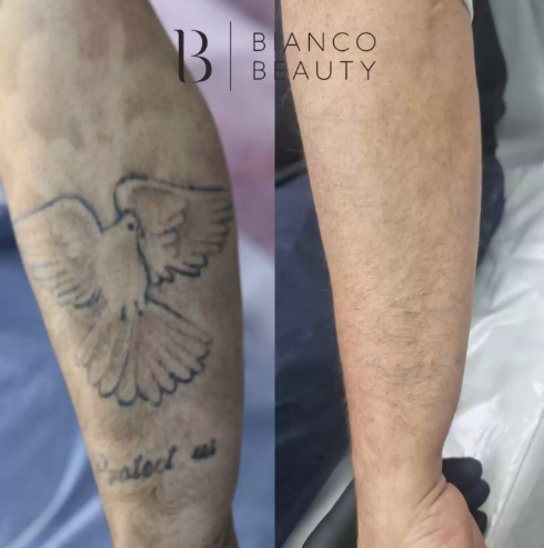 What to Avoid After Tattoo Removal? | by Bianco beauty | May, 2025 | Medium