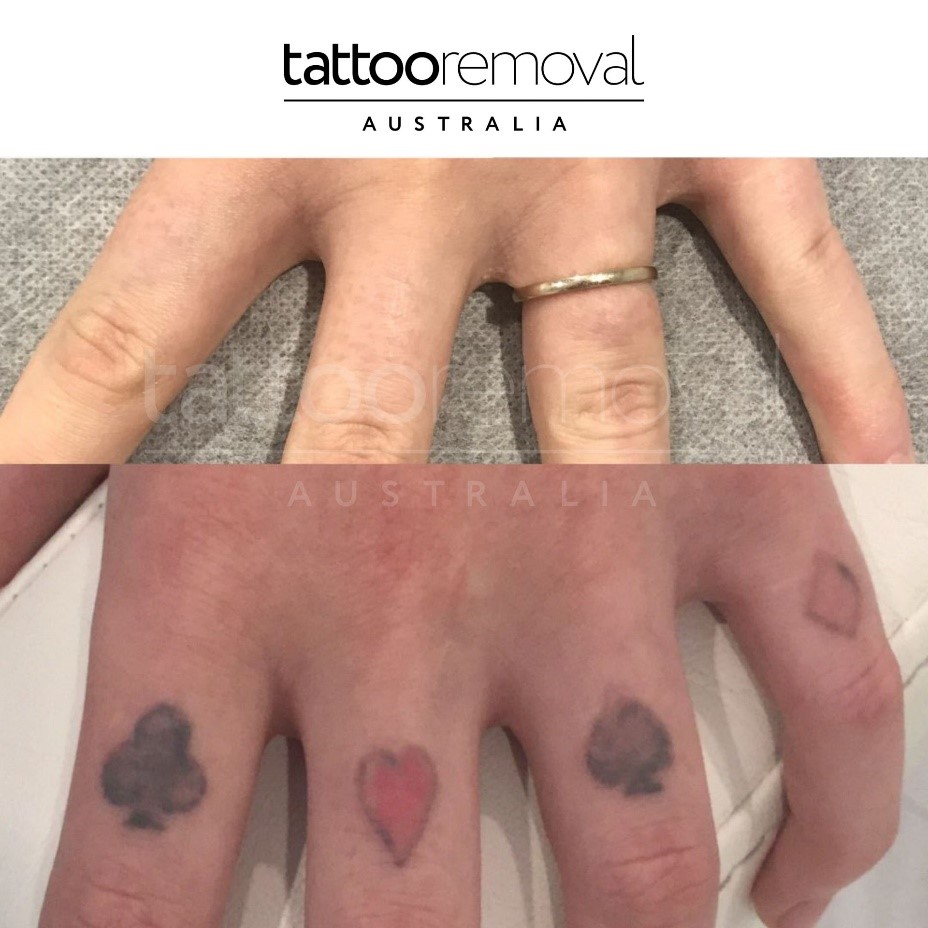 Tattoo Removal Training Cost in Australia (2025 Guide)