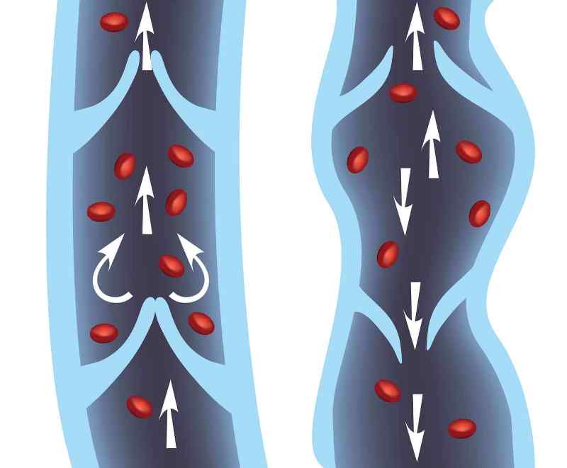 Unveiling Confidence: How to Address Thread Veins Before Summer Begins - Latest News