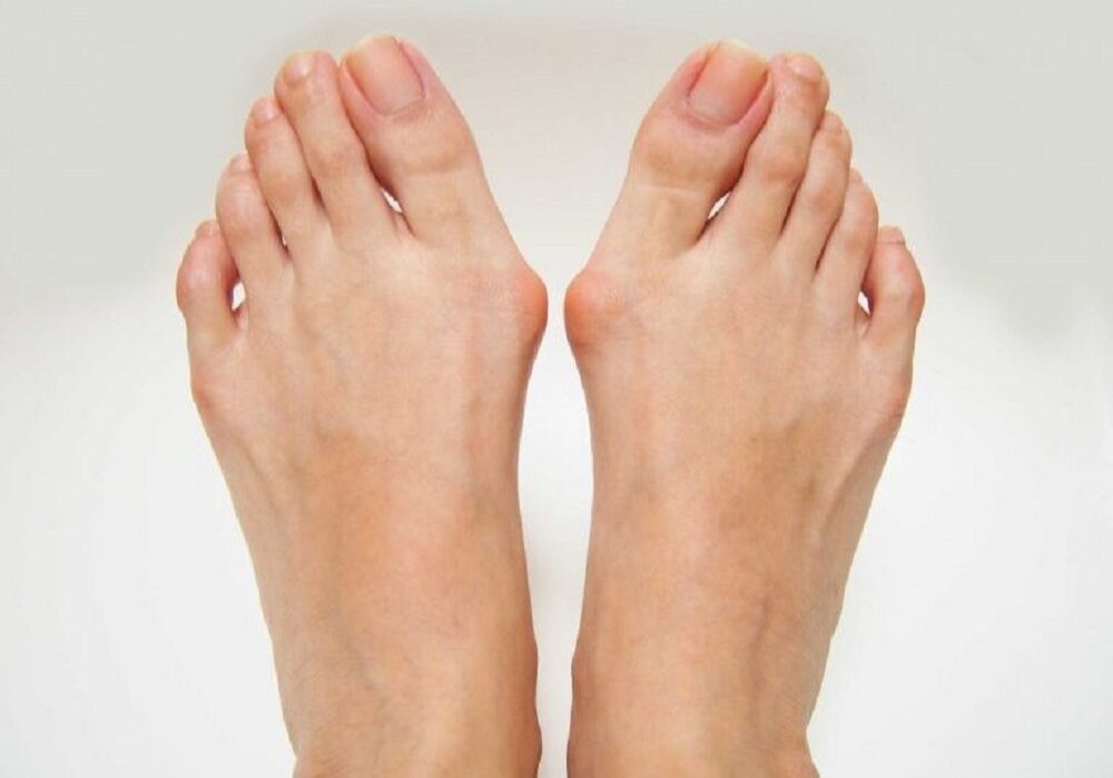 Effective Hammer Toe Treatment in Delhi | Dr. Mathur Orthopaedic – @drmathurorthopaedic02 on Tumblr