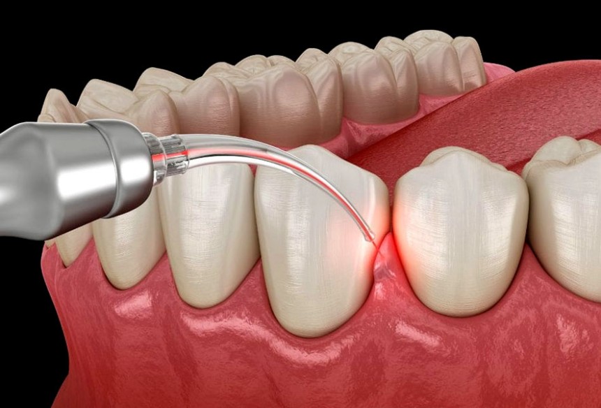 Blogs - Bang Box online - Why Gum Therapy in Kansas City Is Key to Your Oral Health