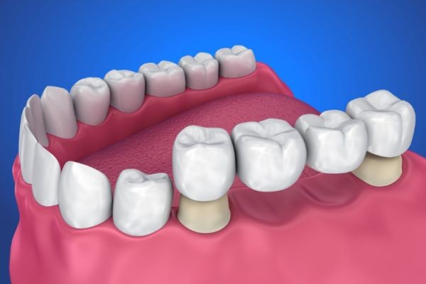 Restore Your Smile with Dental Bridges: A Complete Guide by a Kansas City Dentist | MABIAB