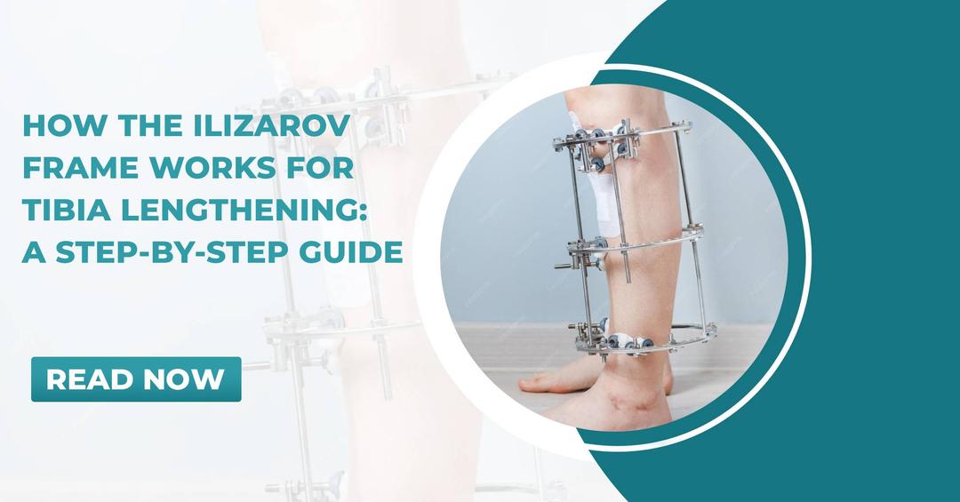 Ilizarov Frame Works for Tibia Lengthening: Step-by-Step
