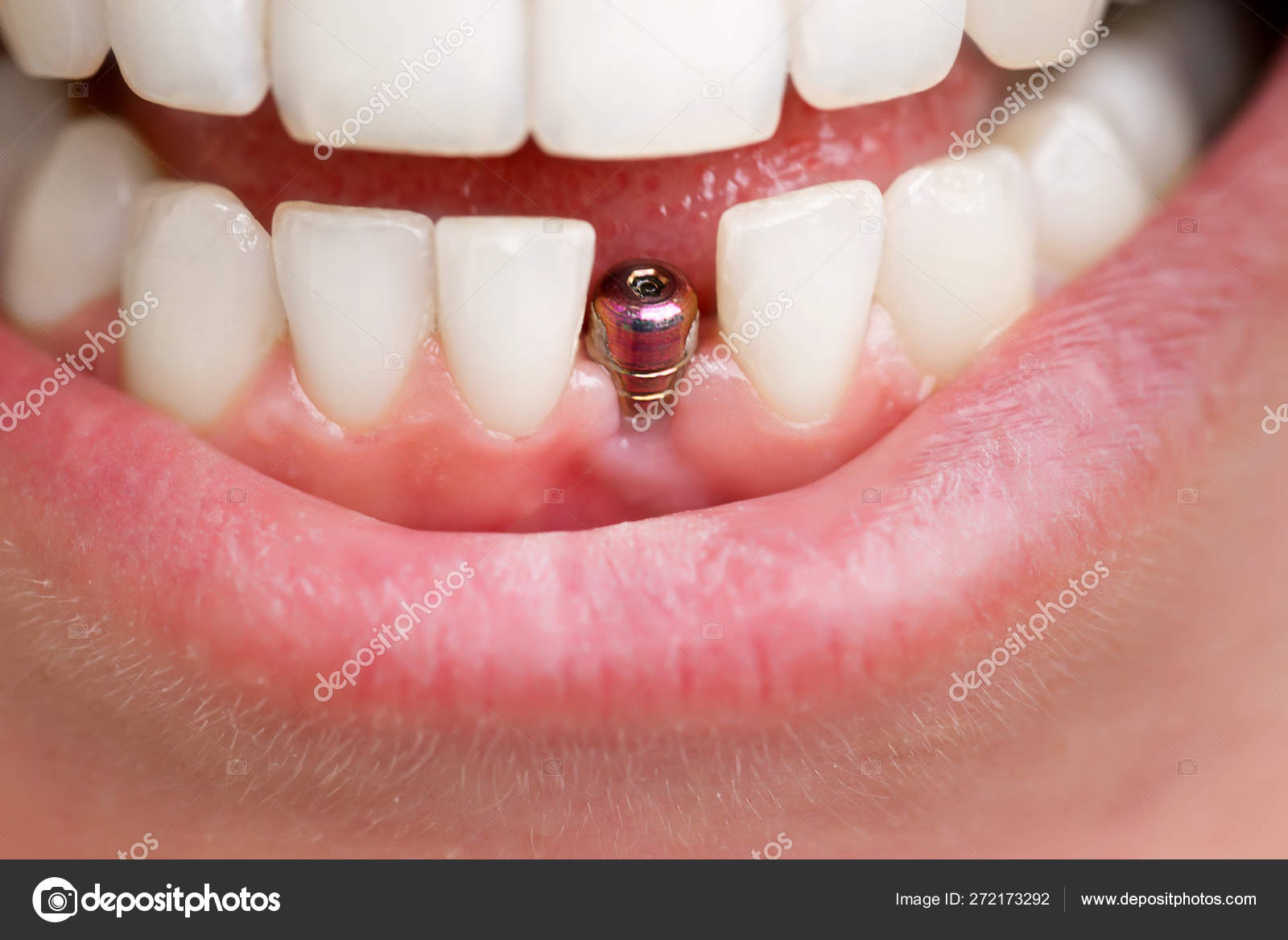 Dental Implants Bella Vista & Norwest | Beyond Smile Dental