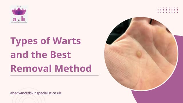 Types of Warts and the Best Removal Method | PPTX