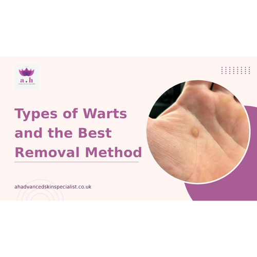 Types of Warts and the Best Removal Method